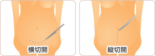 下腹部の皮膚を切開します。横切開・縦切開