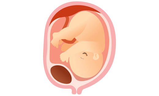 子宮筋腫の場合の出産