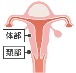 子宮筋腫の種類 粘膜下筋腫