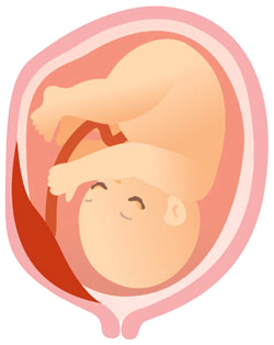 前置胎盤の分類 辺縁前置胎盤