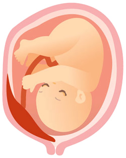 前置胎盤の分類 部分前置胎盤